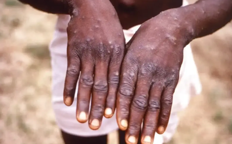 Two hands are being held out to show the lesions from mpox